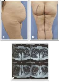 giant myxoid liposarcoma of the gluteal