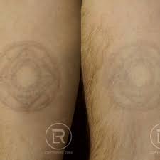 THE BEST 10 Tattoo Removal in Rochester, MN - Last Updated October 2023 -  Yelp
