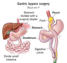 mini gastric byp vs gastric byp