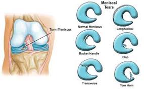 6 meniscus tear types that you need to