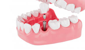 cost and benefits of dental implants