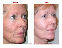 Chemical Peels London, Best Advice, Before & After Pics