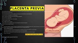 Placenta previa can cause dangerous maternal bleeding. Placenta Previa Theories Types Co Plications Management And Treatment The Science Notes
