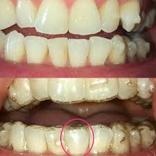 Invisalign is a series of clear trays that you wear to move your teeth. Space Between Top Of Tooth And Tray Invisalign