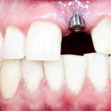 Dental Implants A Complete Guide To Costs Procedures