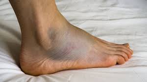 swollen foot ankle or leg causes