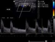 Ultrasound Assessment Of Carotid Arterial Atherosclerotic
