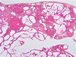 pathology outlines hemangioma variants
