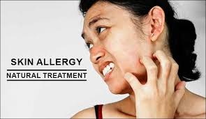 skin allergy naturally