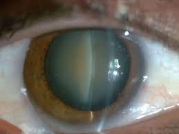 post cataract surgery a post operative