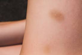 easy bruising symptoms causes and