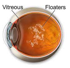This section covers the symptoms related to vitreous separation. Floaters Flashes Lexington Retinal Tears Louisville Retina Associates