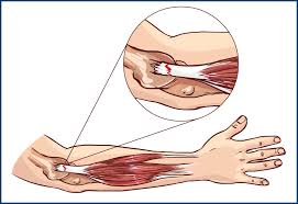 golfers elbow diagnosis and treatment