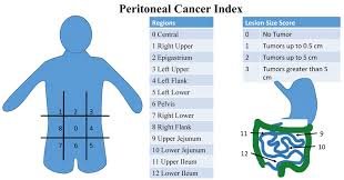 peritoneal cancer index pci scoring