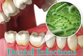 tooth infections emergency treatment