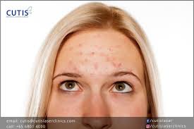 forehead acne cutis laser clinics