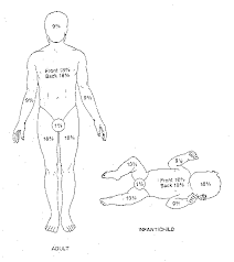 Burn Chart Rule Of Nines Tbsa Total Body Surface Area