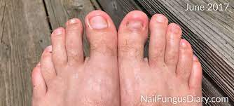 nail fungus update june 2017 nail