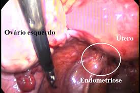 Resultado de imagem para endometriose