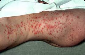 Chlorine and bromine aren't the only. Hot Tub Rash Ireland Pdf Ppt Case Reports Symptoms Treatment