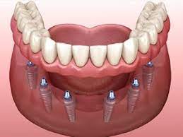 If they've healed enough, the dentist will take a preliminary impression of your mouth to act as a guide for your new, permanent dentures. Tooth Extraction And Implant Front Tooth Implant Molar Implant