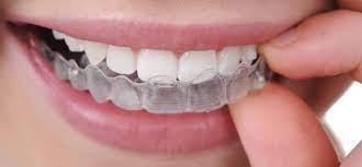 Why Invisalign Braces | Invisible Braces | Scranton PA Invisalign Dentists