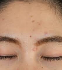 acne between eyebrows causes