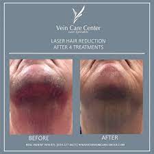 Excess hair growth (hirsutism) slows when high androgen levels decrease. Is Laser Hair Removal Covered By Health Insurance