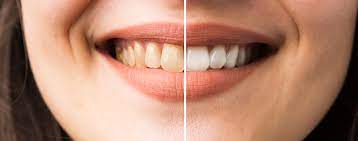 Weiße zähne in wenigen tagen. Zahn Bleaching Focus Arztsuche