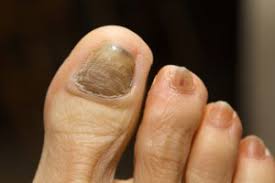 thick toenails in the elderly