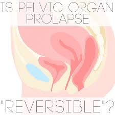 is pelvic organ prolapse reversible