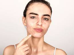 seek professional help for your acne