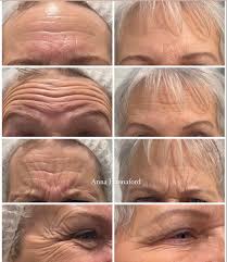 dermal fillers vs anti wrinkle