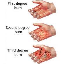Do You Know The Differences Between 1st 2nd And 3rd Degree