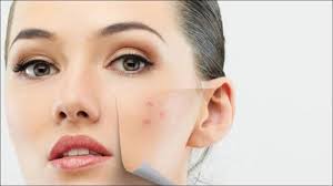 cure acne