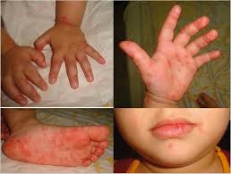 What to Know About Hand, Foot, and Mouth Disease - Keep Kids Healthy