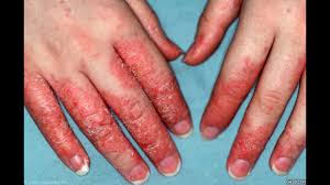 natural eczema cure remedy how to