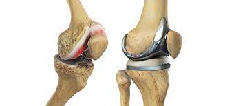 total knee replacement tkr dr atul