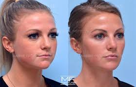 full face contouring before after