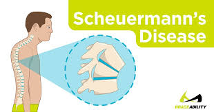 A normal, healthy spine should have curves in it. Scheuermann S Disease The Truth About Your Child S Hunched Back