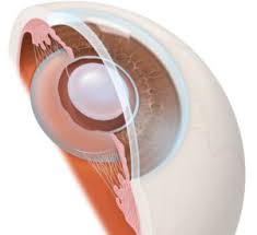 intraocular lenses cal surgical