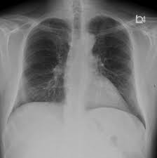 If the asbestosis is severe, the tissue in both lungs might be affected, giving them a honeycomb appearance. Mesothelioma Radiology Case Radiopaedia Org