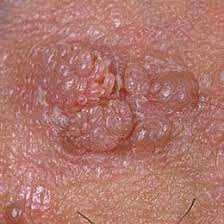 wart removal miami hpv warts