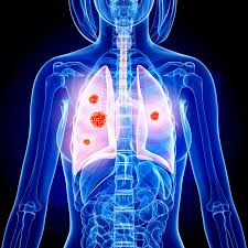 The left lung contains superior and. The 8 Red Flag Signs Of Lung Cancer You Should Never Ignore