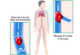 The pain may feel like a cramp or charley horse. Signs Symptoms Of Blood Clotting Disorders Ihtc