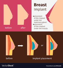 Breast Implants Infographics
