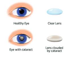 cataract surgery in honolulu hi