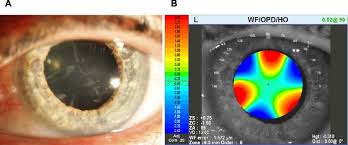 Anterior Cortical Cataract In The Left Eye Of A 72 Year Old