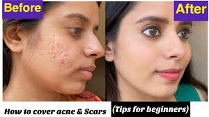 cover acne e skin pigment scars