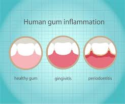 what causes gum disease birmingham
